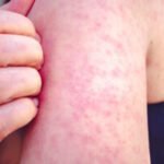 String of outbreaks tests US public health system amid funding cuts, vaccine resistance