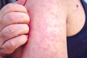 String of outbreaks tests US public health system amid funding cuts, vaccine resistance